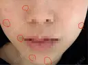 ほくろ・いぼ切除（肌） KARIS beauty clinic DAY 29 サムネイル用