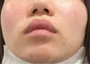 ピーリング（ニキビ・毛穴） 大美会クリニック 神戸院 DAY 0 サムネイル用