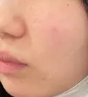 ピーリング（ニキビ・毛穴） 大美会クリニック 神戸院 DAY 0 サムネイル用