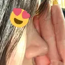 鼻尖形成（切開） / 軟骨移植 / 鼻尖縮小 / 鼻翼基部形成（貴族手術） / ヒアルロン酸注入（鼻翼基部） 東京シンデレラ美容外科 新宿院 DAY 35 サムネイル用