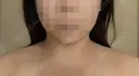 ボトックス（エラ・小顔） / 脂肪溶解注射（顔） おおたかの森ビューティークリニック AFTER サムネイル用