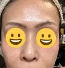 ピコレーザートーニング（美白・肝斑） / フラクショナルレーザー（毛穴・ニキビ跡） Mavie Beauty Clinic （マヴィービューティークリニック） DAY 7 サムネイル用