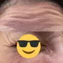 ボトックス（あご） / ボトックス（口角） / ボトックス（眉間） / ボトックス（目尻） / ボトックス（額） DMTC CLINIC 日本橋院 DAY 0 サムネイル用