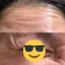 ボトックス（あご） / ボトックス（口角） / ボトックス（眉間） / ボトックス（目尻） / ボトックス（額） DMTC CLINIC 日本橋院 DAY 1 サムネイル用