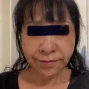 その他（目元） / 糸リフト / ボトックス（あご） / ヒアルロン酸注入（あご） / ヒアルロン酸注入（唇） / シワ取りボトックス / ヒアルロン酸注入（鼻翼基部） ルラ美容クリニック 仙台院 / ルラスキンクリニック 仙台院 AFTER サムネイル用