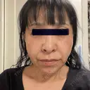 その他（目元） / 糸リフト / ボトックス（あご） / ヒアルロン酸注入（あご） / ヒアルロン酸注入（唇） / シワ取りボトックス / ヒアルロン酸注入（鼻翼基部） ルラ美容クリニック 仙台院 / ルラスキンクリニック 仙台院 DAY 2 サムネイル用