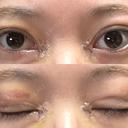 二重埋没 / 目頭切開 アリエル美容クリニック 郡山院 DAY 6 サムネイル用
