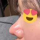 鼻尖形成（切開） / 軟骨移植 / 鼻尖縮小 / 鼻翼基部形成（貴族手術） / ヒアルロン酸注入（鼻翼基部） 東京シンデレラ美容外科 新宿院 DAY 38 サムネイル用