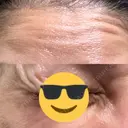 ボトックス（あご） / ボトックス（口角） / ボトックス（眉間） / ボトックス（目尻） / ボトックス（額） DMTC CLINIC 日本橋院 DAY 4 サムネイル用