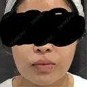 その他（輪郭） / 美肌レーザー / 美白レーザー ビューティー和心クリニック 浅草院 AFTER サムネイル用