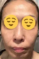 ピコレーザートーニング（美白・肝斑） / フラクショナルレーザー（毛穴・ニキビ跡） Mavie Beauty Clinic （マヴィービューティークリニック） DAY 14 サムネイル用