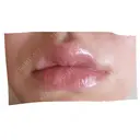 ヒアルロン酸注入（唇） シンデレラ＆ダヴィンチクリニック AFTER サムネイル用