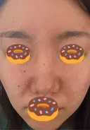 イオン導入 / ルメッカ ルラ美容クリニック 千葉院 / ルラスキンクリニック 千葉院 AFTER サムネイル用