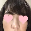 小鼻縮小（切開） JUN CLINIC DAY 9 サムネイル用