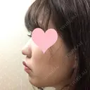 小鼻縮小（切開） JUN CLINIC DAY 9 サムネイル用