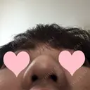 小鼻縮小（切開） JUN CLINIC DAY 9 サムネイル用