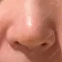 鼻尖形成（切開） / 軟骨移植 / 鼻孔縁下降 / 鼻柱下降・鼻唇角形成（猫手術） もとび美容外科クリニック 新宿院 DAY 6 サムネイル用