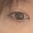 その他（目元） ネビュラクリニック 広島院 AFTER サムネイル用