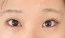 目尻切開 / タレ目形成・グラマラスライン（埋没） LOUIS CLINIC 二子玉川院【ルイクリニック】 DAY 2 サムネイル用