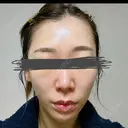 糸リフト BON BON CLINIC 銀座駅前本院 DAY 8 サムネイル用