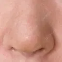 鼻尖形成（切開） / 軟骨移植 / 鼻孔縁下降 / 鼻柱下降・鼻唇角形成（猫手術） もとび美容外科クリニック 新宿院 DAY 8 サムネイル用