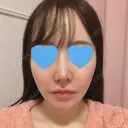 鼻尖形成（切開） / 小鼻縮小（切開） / ワシ鼻修正・ハンプ切除 / 鼻柱下降・鼻唇角形成（猫手術） ASTRA BEAUTY CLINIC DAY 29 サムネイル用