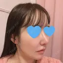 鼻尖形成（切開） / 小鼻縮小（切開） / ワシ鼻修正・ハンプ切除 / 鼻柱下降・鼻唇角形成（猫手術） ASTRA BEAUTY CLINIC DAY 29 サムネイル用
