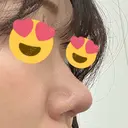 鼻尖形成（切開） / 軟骨移植 / 鼻尖縮小 / 鼻翼基部形成（貴族手術） / ヒアルロン酸注入（鼻翼基部） 東京シンデレラ美容外科 新宿院 DAY 43 サムネイル用