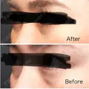 クマ治療 / 下まぶたの脂肪取り Tokyo Tensei Clinic 新宿院 DAY 7 サムネイル用