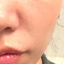 ボトックス（あご） / ボトックス（口角） / ボトックス（額） BiBiクリニック AFTER サムネイル用