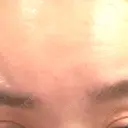 ボトックス（あご） / ボトックス（口角） / ボトックス（額） BiBiクリニック DAY 0 サムネイル用