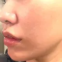 ボトックス（あご） / ボトックス（口角） / ボトックス（額） BiBiクリニック DAY 0 サムネイル用