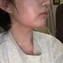 その他（輪郭） / その他（肌） / RF（高周波）たるみ治療 大美会クリニック 神戸院 DAY 0 サムネイル用