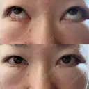 クマ治療 / 下まぶたの脂肪取り / ヒアルロン酸注入（目の下） ROOTS Clinic DAY 1 サムネイル用