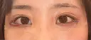 下まぶたの脂肪取り / タレ目形成・グラマラスライン（切開） / 目尻靭帯移動 池袋麗歯科・美容皮膚科 DAY 2 サムネイル用