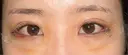 下まぶたの脂肪取り / タレ目形成・グラマラスライン（切開） / 目尻靭帯移動 池袋麗歯科・美容皮膚科 DAY 3 サムネイル用