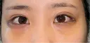 下まぶたの脂肪取り / タレ目形成・グラマラスライン（切開） / 目尻靭帯移動 池袋麗歯科・美容皮膚科 DAY 5 サムネイル用