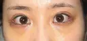 下まぶたの脂肪取り / タレ目形成・グラマラスライン（切開） / 目尻靭帯移動 池袋麗歯科・美容皮膚科 DAY 7 サムネイル用