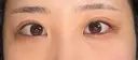 下まぶたの脂肪取り / タレ目形成・グラマラスライン（切開） / 目尻靭帯移動 池袋麗歯科・美容皮膚科 AFTER サムネイル用