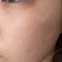 イオン導入 / 毛穴洗浄（ハイドラフェイシャルなど） / 光治療（フォトフェイシャルなど） / その他（鼻） ルラ美容クリニック 札幌本院 DAY 0 サムネイル用