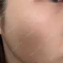 イオン導入 / 毛穴洗浄（ハイドラフェイシャルなど） / 光治療（フォトフェイシャルなど） / その他（鼻） ルラ美容クリニック 札幌本院 DAY 0 サムネイル用