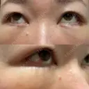 クマ治療 / 下まぶたの脂肪取り / ヒアルロン酸注入（目の下） ROOTS Clinic DAY 2 サムネイル用