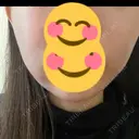 脂肪溶解注射（顔） AZ BEAUTY CLINIC DAY 1 サムネイル用