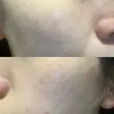 光治療（フォトフェイシャルなど） 小木曽クリニック DAY 43 サムネイル用