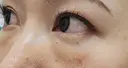 クマ治療 / 下まぶたたるみ取り 湘南美容クリニック 千葉センシティ院 DAY 16 サムネイル用