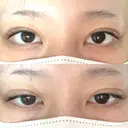 二重埋没 BELINDA CLINIC（ベリンダクリニック）新宿院 AFTER サムネイル用