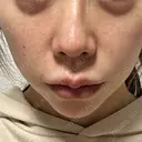 エレクトロポレーション / ルメッカ ルラ美容クリニック 大阪心斎橋院 AFTER サムネイル用