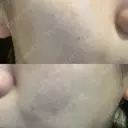 光治療（フォトフェイシャルなど） 小木曽クリニック AFTER サムネイル用