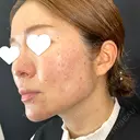 サブシジョン 藤・ナチュレ美容クリニック 銀座院 DAY 12 サムネイル用