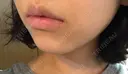 ヒアルロン酸注入（唇） / ボトックス（口角） TCB東京中央美容外科 堺院 DAY 8 サムネイル用